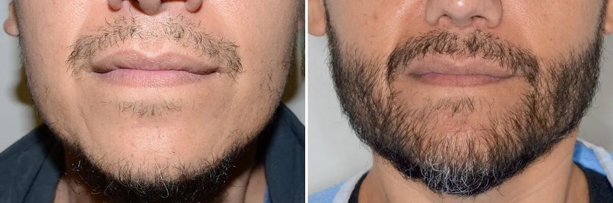 Beard Transplant before and after, frontal.