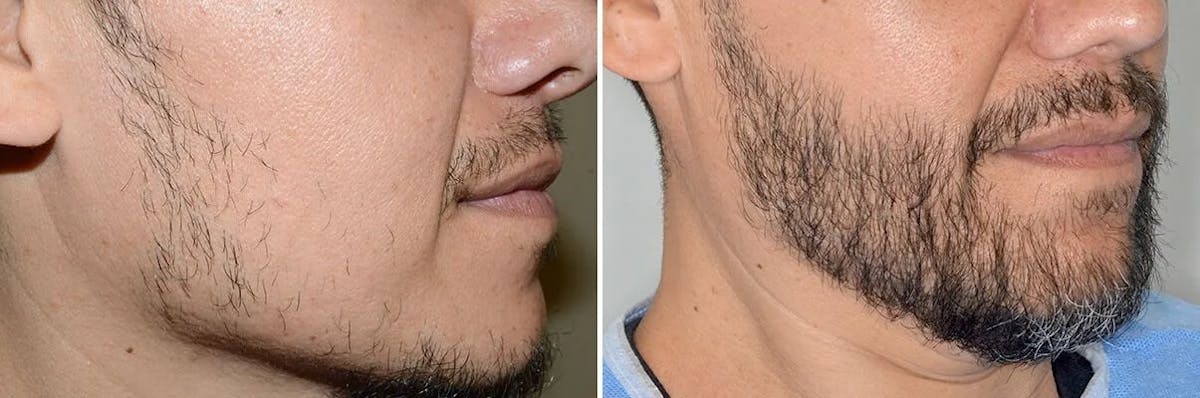 Beard Transplant before and after, oblique right.