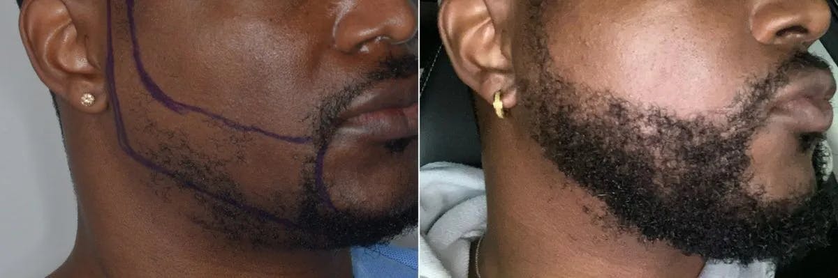 Beard Transplant before and after, oblique right.