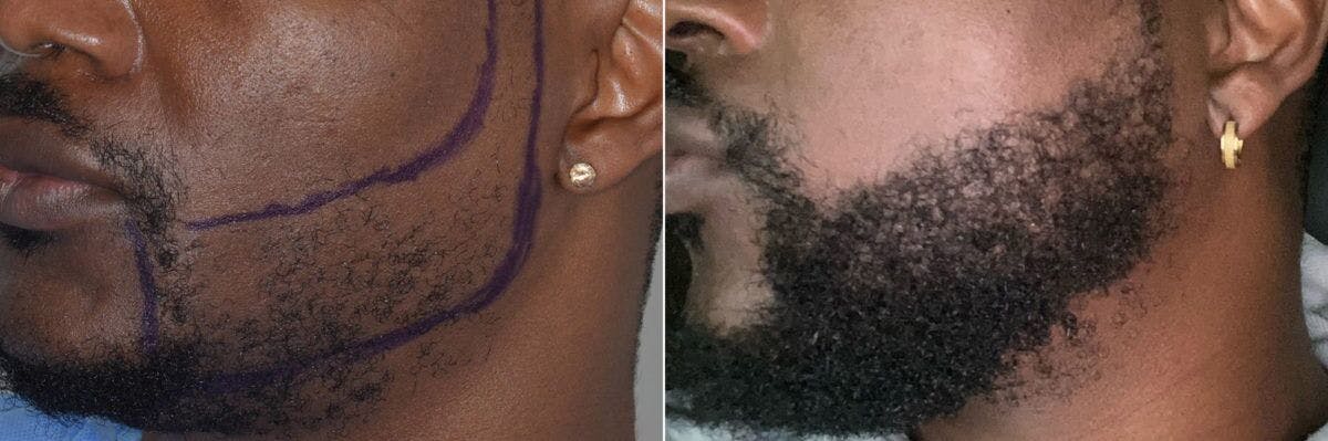 Beard Transplant before and after, oblique left.