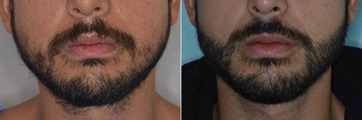 Beard Transplant before and after, frontal.