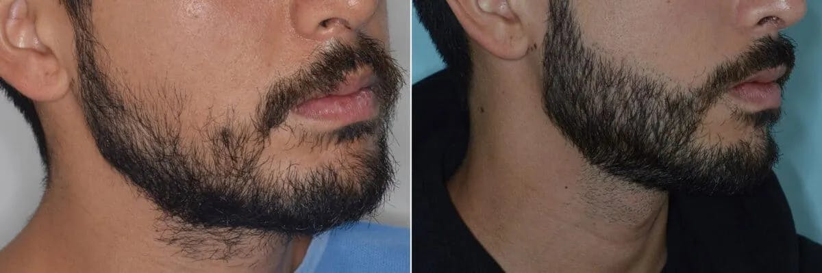 Beard Transplant before and after, oblique right.