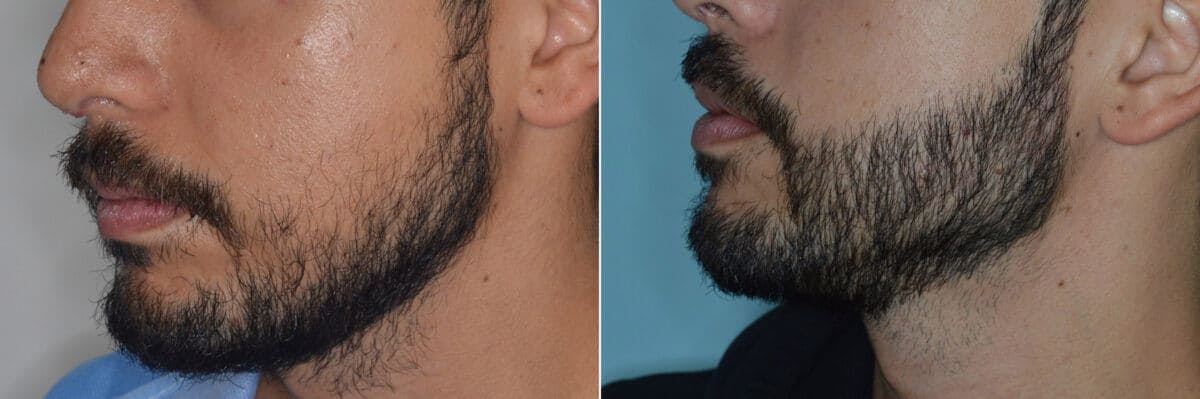 Beard Transplant before and after, lateral left.