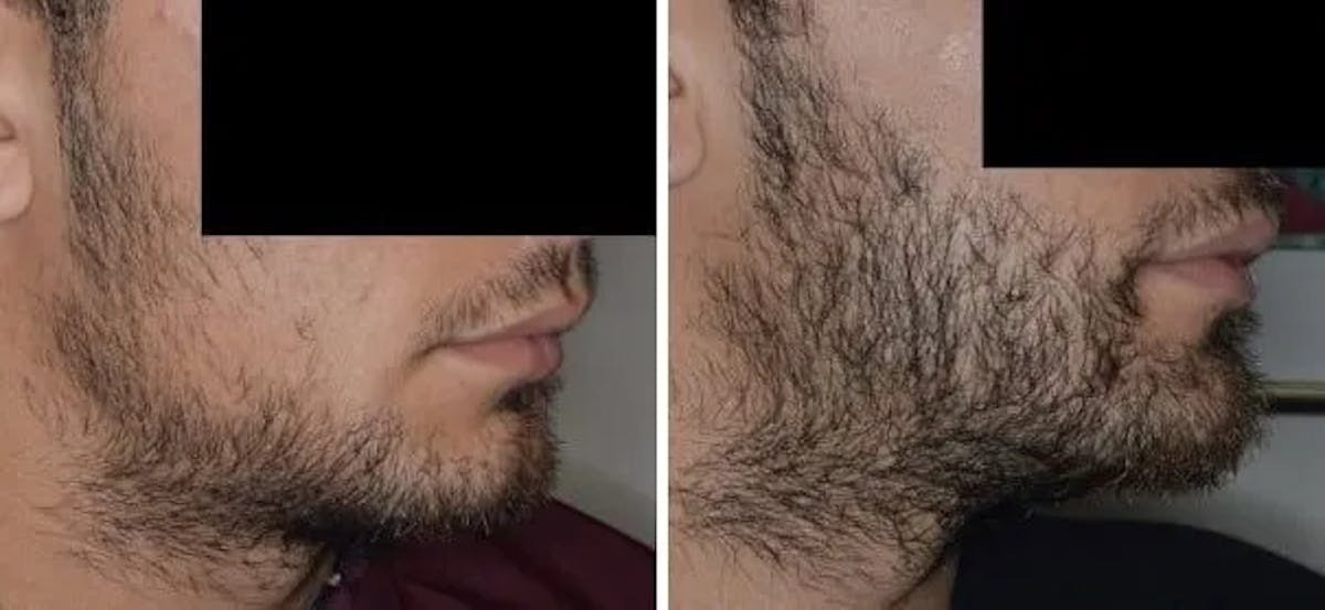 Beard Transplant before and after, lateral right.