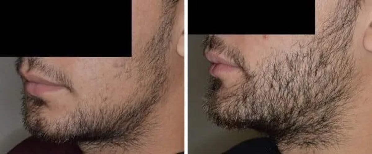 Beard Transplant before and after, lateral left.