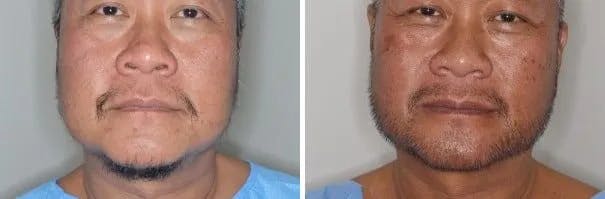 Beard Transplant before and after, frontal.