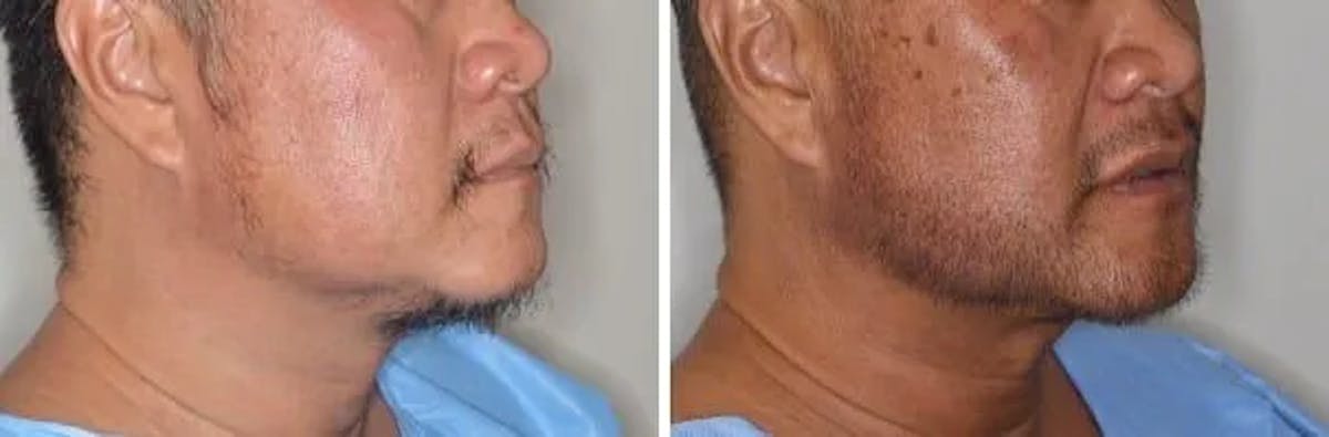 Beard Transplant before and after, oblique right.