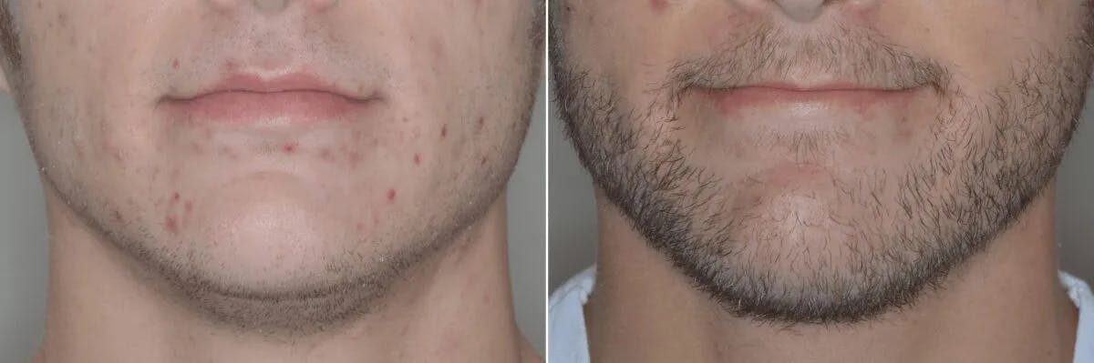 Beard Transplant before and after, frontal.