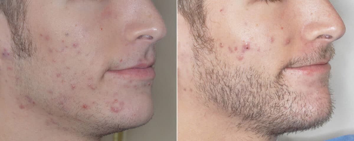 Beard Transplant before and after, oblique right.