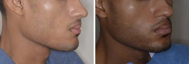 Beard Transplant before and after, oblique right.