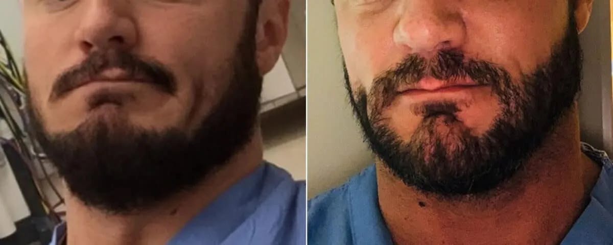 Beard Transplant before and after, frontal.