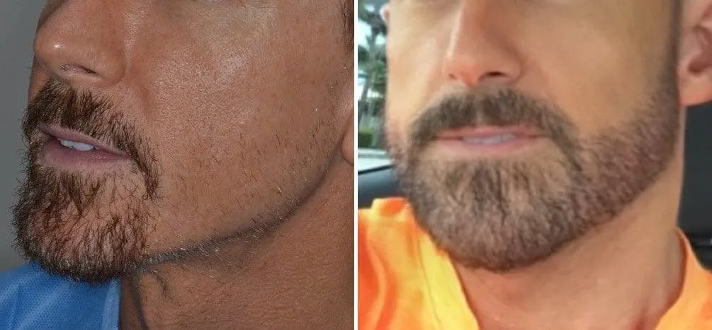 Beard Transplant before and after, oblique left.