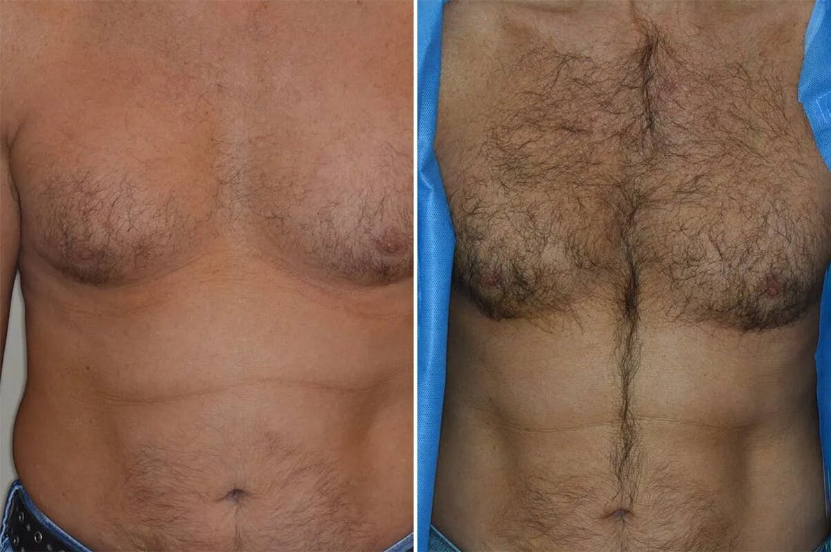 Body Hair Transplant before and after, frontal.
