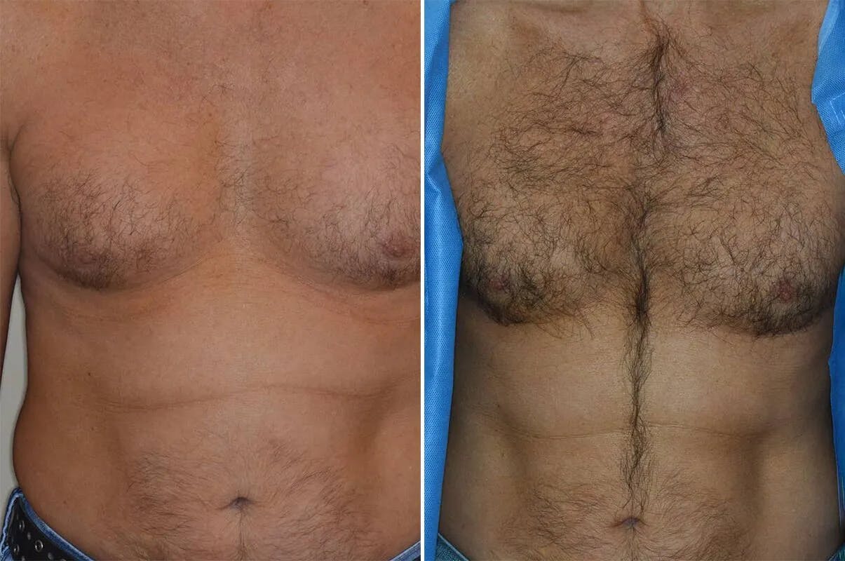 Body Hair Transplant before and after, frontal.