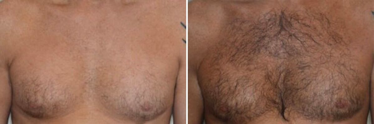 Body Hair Transplant before and after, frontal.