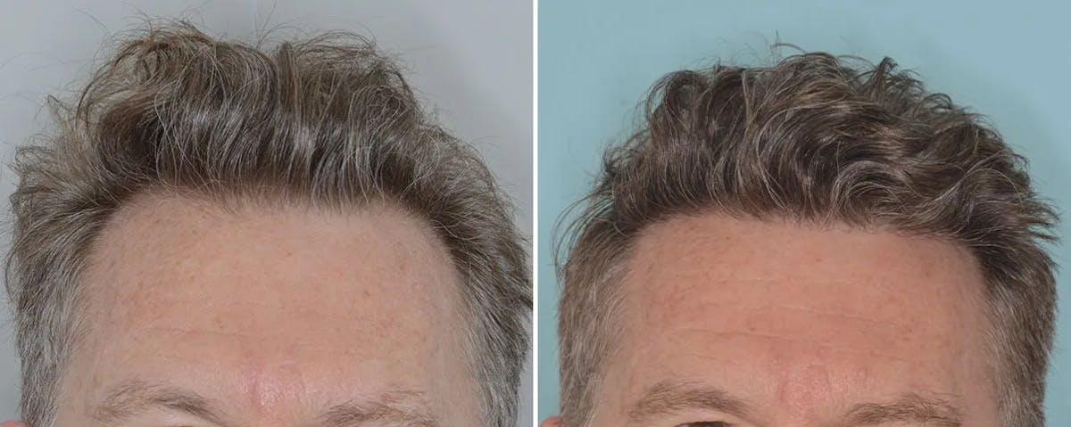 Hair Transplant before and after, frontal.