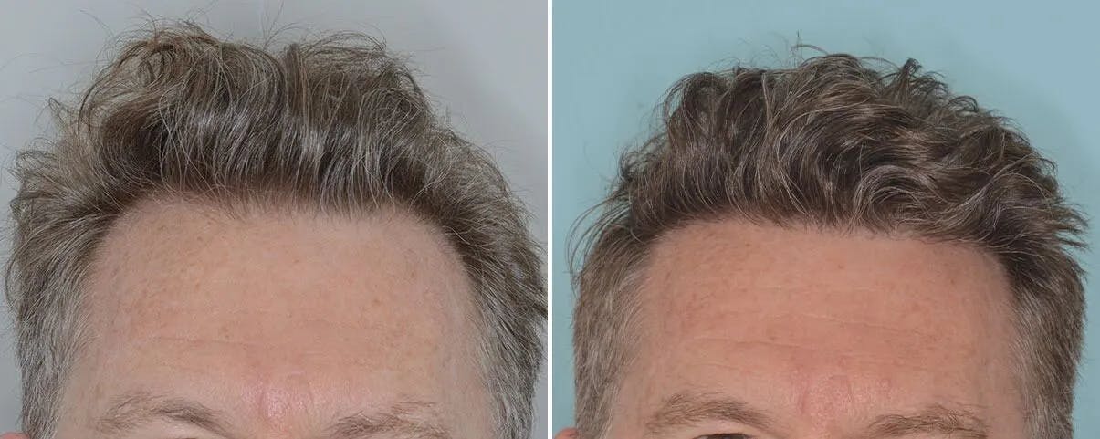 Hair Transplant before and after, frontal.