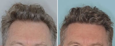 Hair Transplant before and after, frontal.
