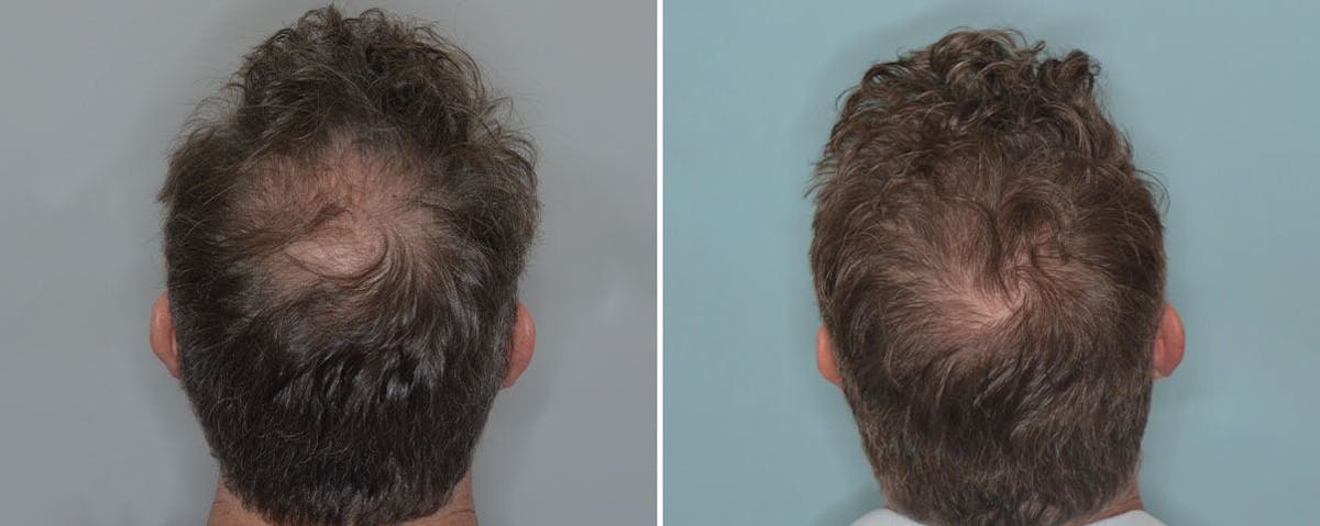 Hair Transplant before and after, upper back.