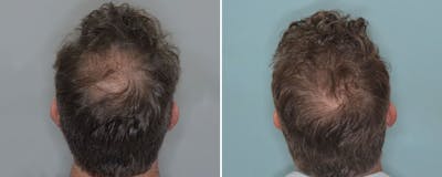 Hair Transplant before and after, upper back.