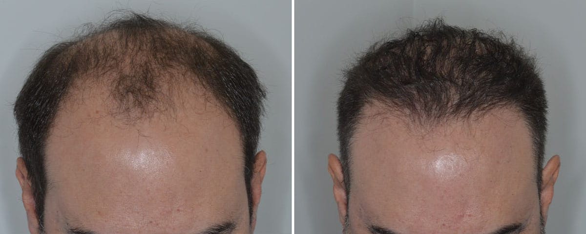 Hair Transplant before and after, frontal.