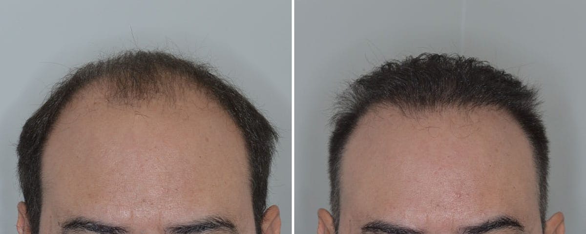 Hair Transplant before and after, frontal.