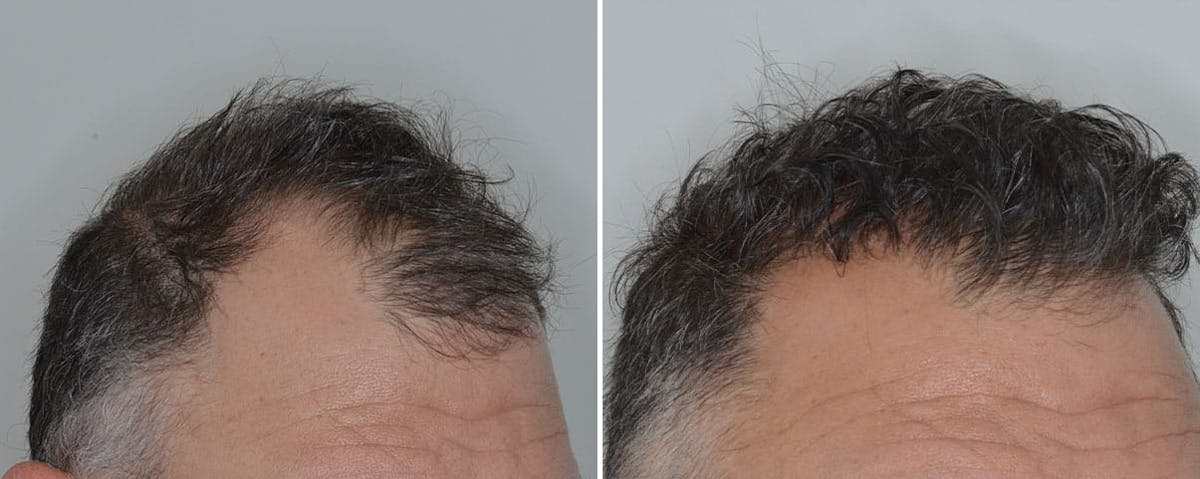 Hair Transplant before and after, lateral right.