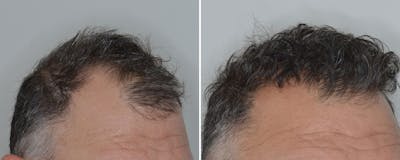 Hair Transplant before and after, lateral right.