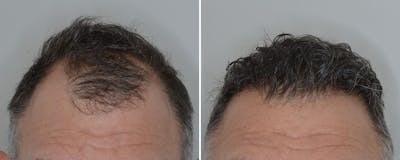 Hair Transplant before and after, frontal.