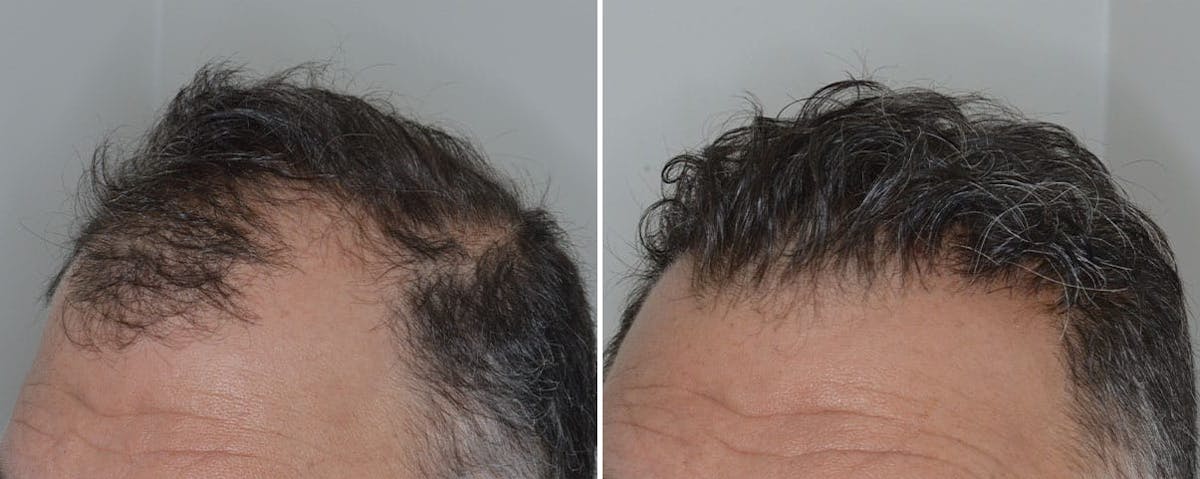 Hair Transplant before and after, lateral left.