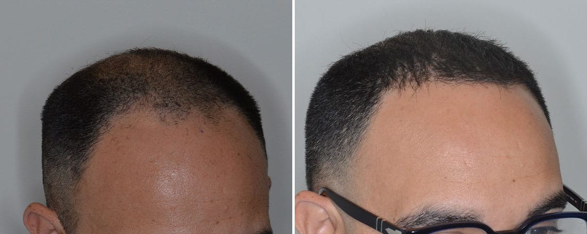 Hair Transplant before and after, lateral right.