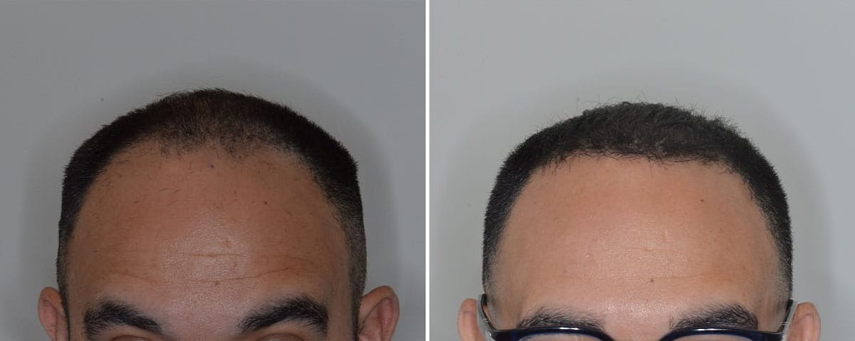 Hair Transplant before and after, frontal.