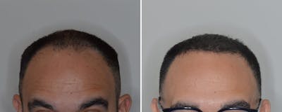 Hair Transplant before and after, frontal.