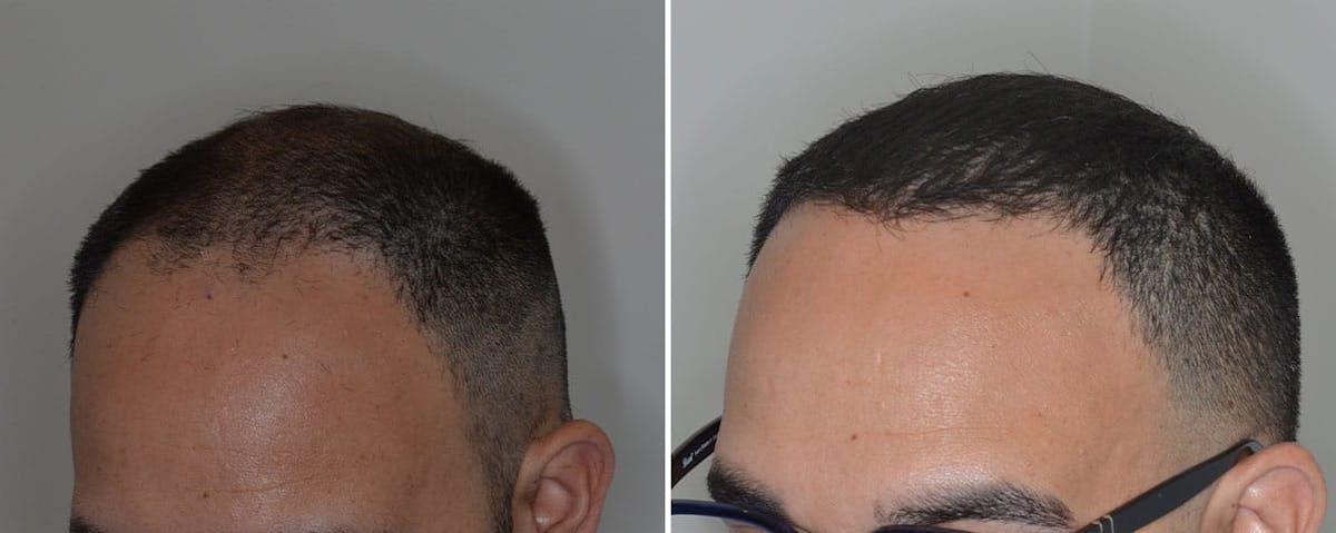 Hair Transplant before and after, lateral left.