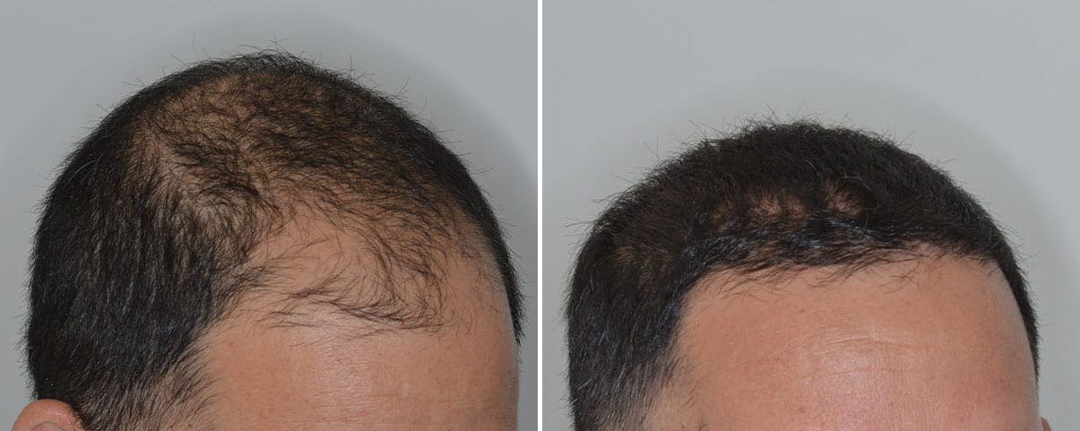 Hair Transplant before and after, lateral right.