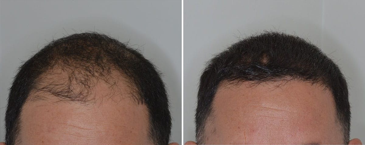 Hair Transplant before and after, frontal.