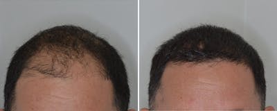 Hair Transplant before and after, frontal.