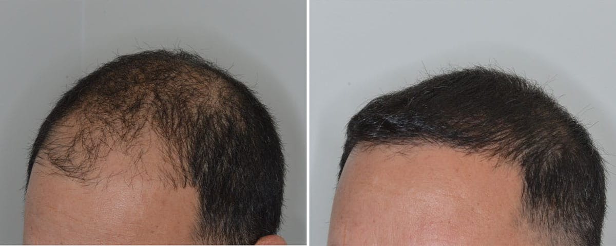 Hair Transplant before and after, lateral left.