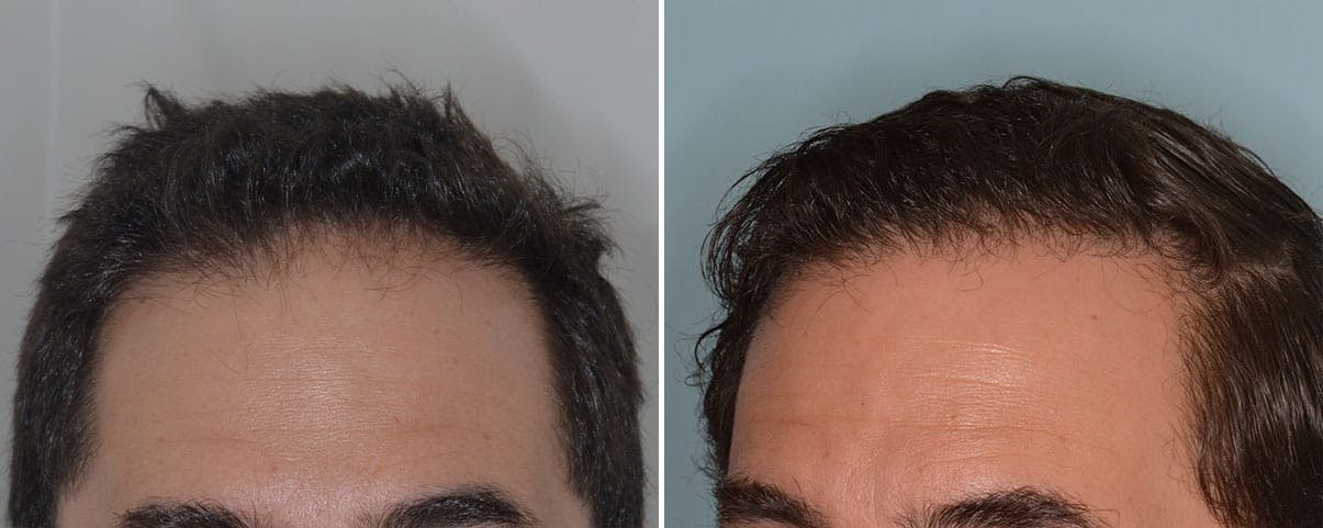 Hair Transplant before and after, lateral left.