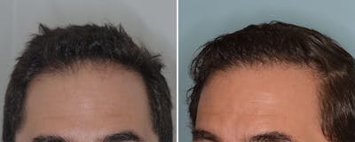 Hair Transplant before and after, lateral left.