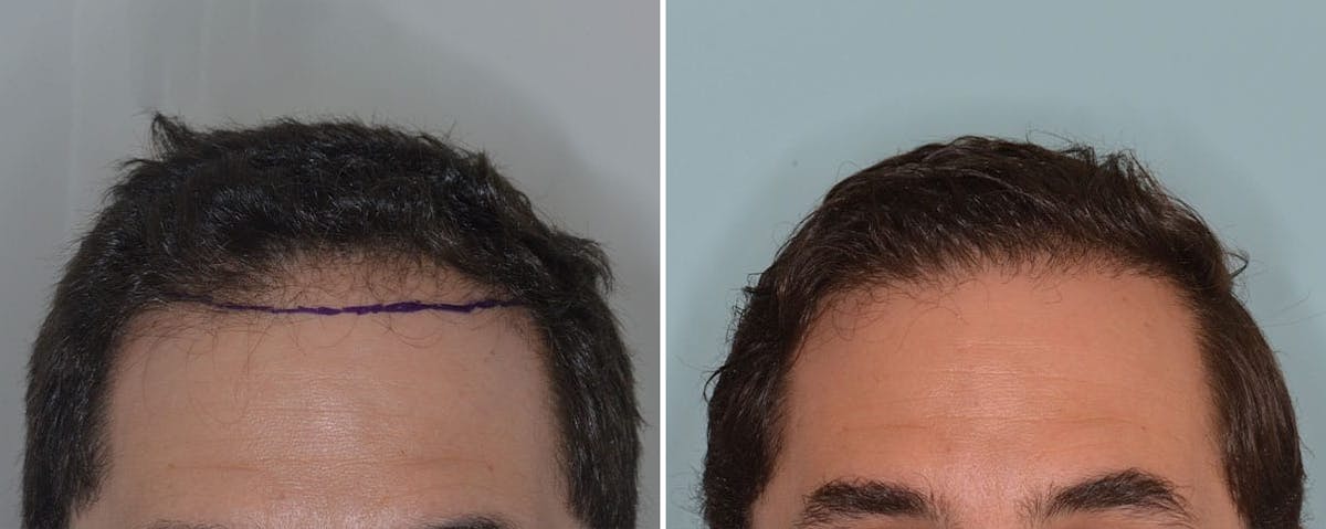 Hair Transplant before and after, frontal.