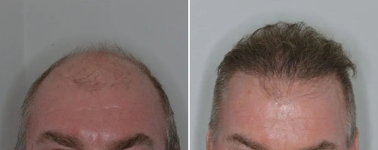 Hair Transplant before and after, frontal.