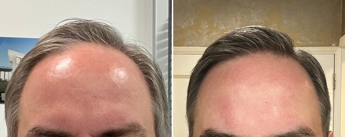 Hair Transplant before and after, frontal.