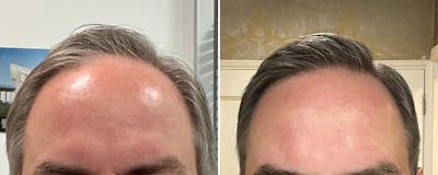 Hair Transplant before and after, frontal.