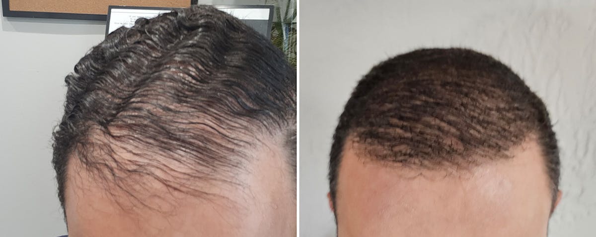 Hair Transplant before and after, frontal.