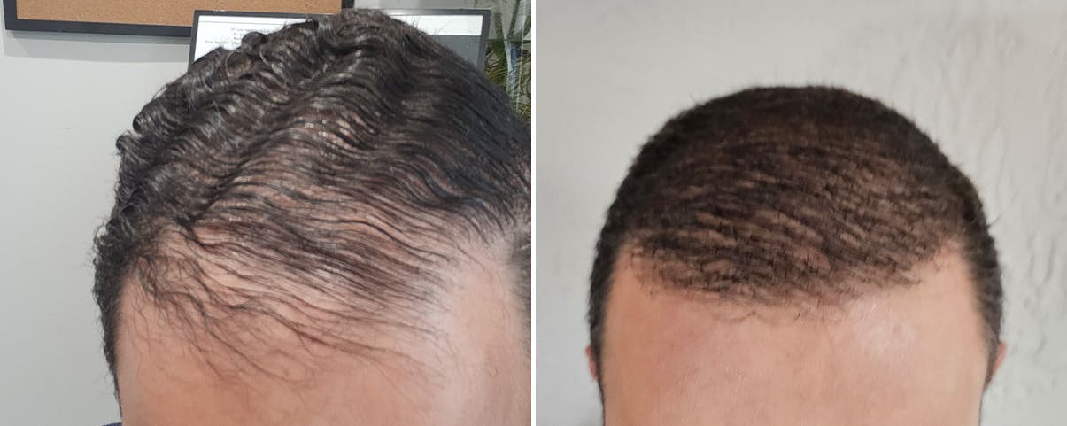 Hair Transplant before and after, frontal.