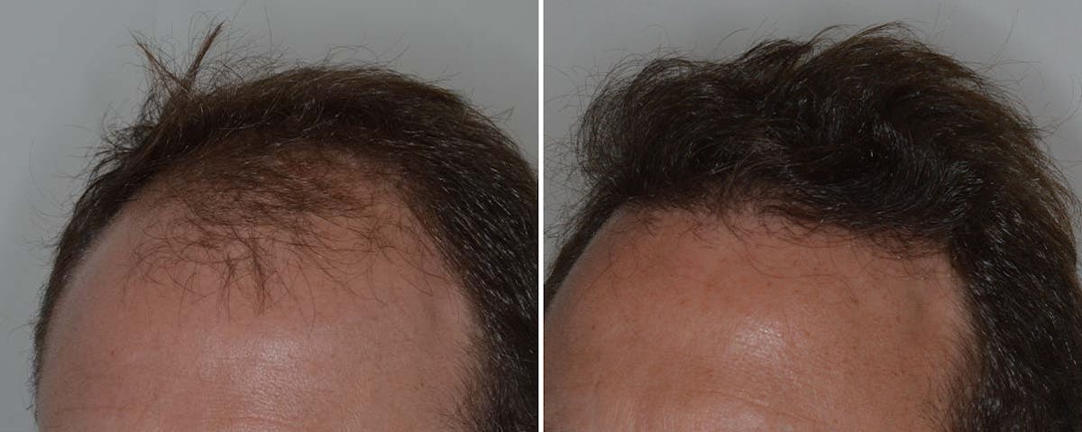 Hair Transplant before and after, lateral left.