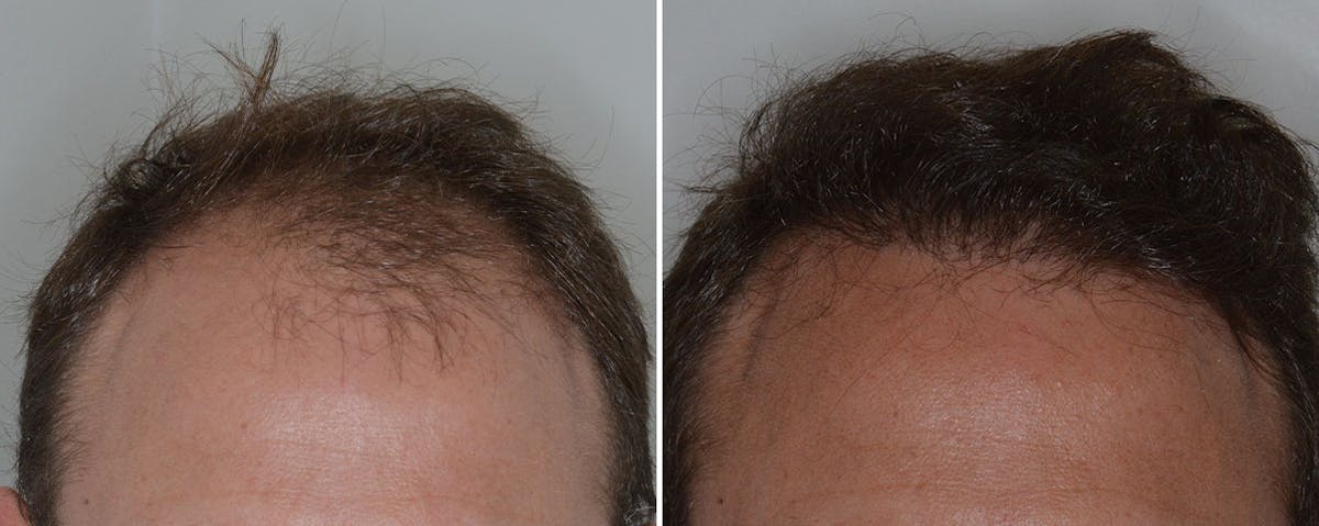 Hair Transplant before and after, frontal.