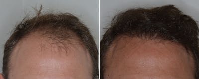 Hair Transplant before and after, frontal.