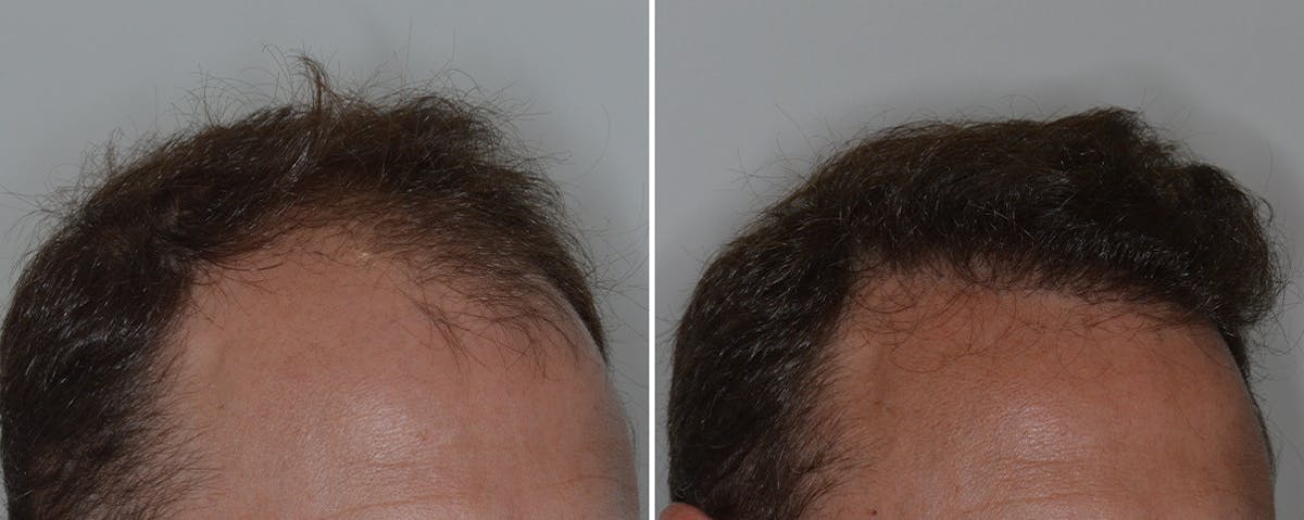 Hair Transplant before and after, lateral right.